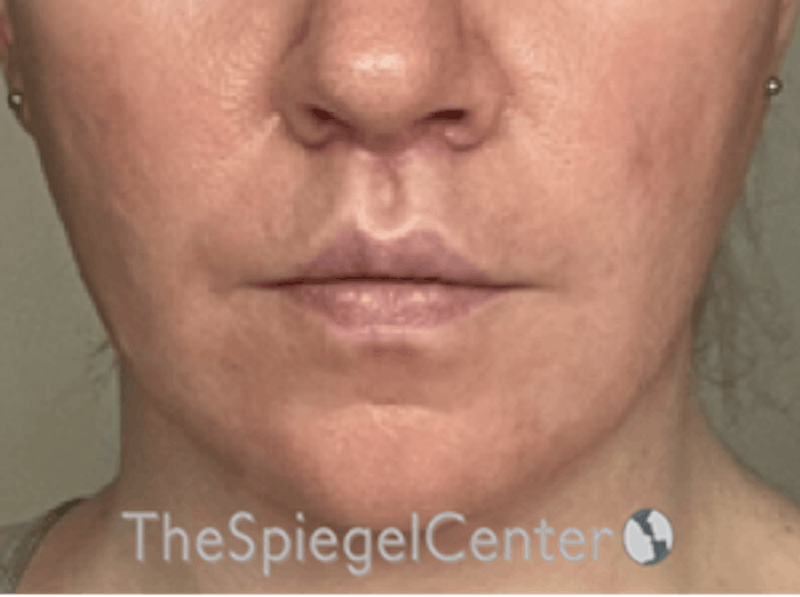 Lip Augmentation / Lip Implant / Lip Lift Before & After Gallery - Patient 162629911 - Image 2