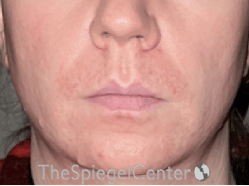 Lip Lift Before & After Gallery - Patient 162629911 - Image 1