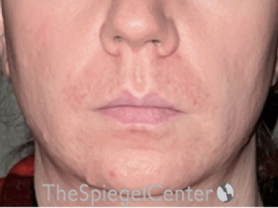 Lip Lift Before & After Gallery - Patient 162629911 - Image 1