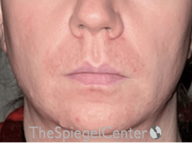 Lip Augmentation / Lip Implant / Lip Lift Before & After Gallery - Patient 162629911 - Image 1
