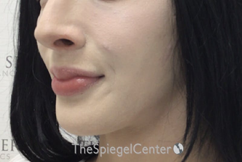 Mandible Contouring Before & After Gallery - Patient 162630012 - Image 4