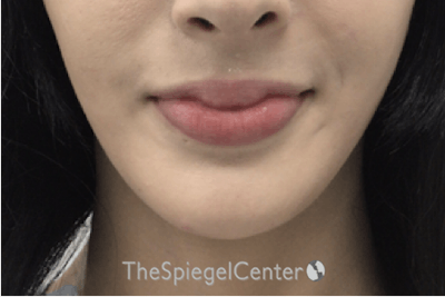 Mandible Contouring Before & After Gallery - Patient 162630012 - Image 2
