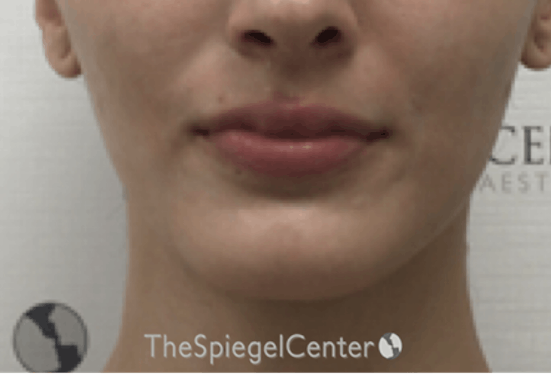 Mandible Contouring Before & After Gallery - Patient 162630012 - Image 1