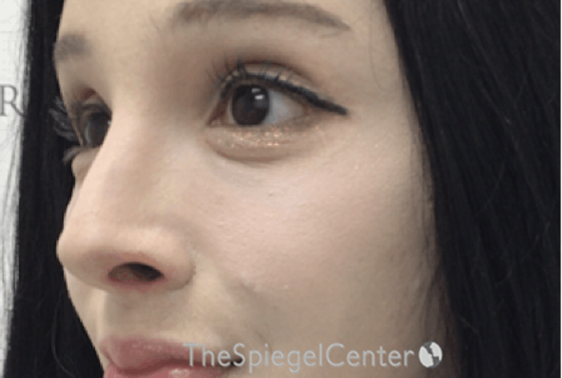 Cheek Implants Before & After Gallery - Patient 162630028 - Image 4