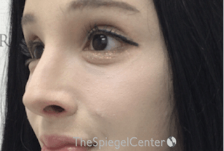 Cheek Implants Before & After Gallery - Patient 162630028 - Image 4