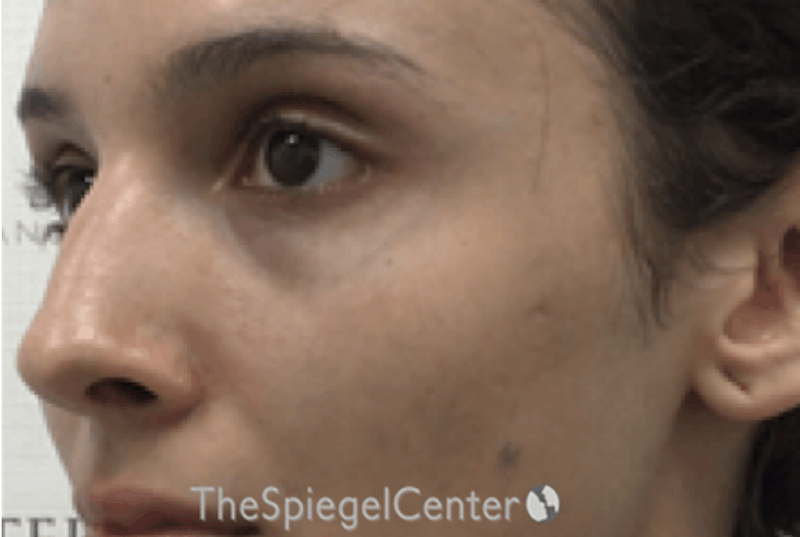 Cheek Implants Before & After Gallery - Patient 162630028 - Image 3