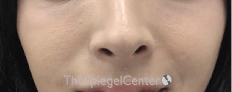 Cheek Implants Before & After Gallery - Patient 162630028 - Image 2