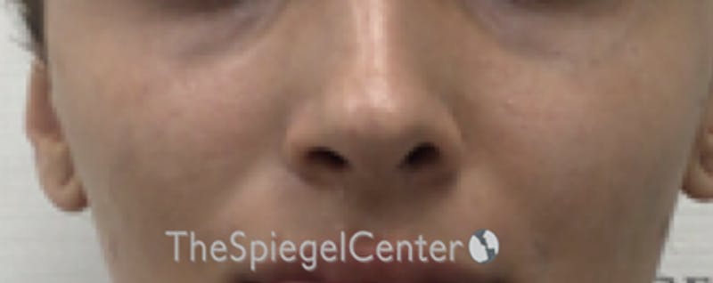 Cheek Implants Before & After Gallery - Patient 162630028 - Image 1