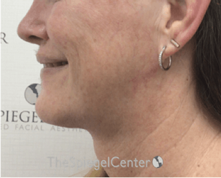 Facetite / Necktite / Embrace / Accutite Before & After Gallery - Patient 162630063 - Image 4
