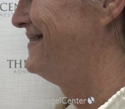 Facetite / Necktite / Embrace / Accutite Before & After Gallery - Patient 162630063 - Image 3