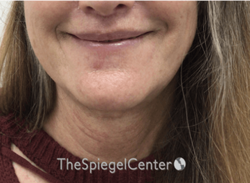 Facetite / Necktite / Embrace Before & After Gallery - Patient 162630063 - Image 4