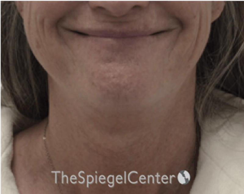 Facetite / Necktite / Embrace / Accutite Before & After Gallery - Patient 162630063 - Image 1