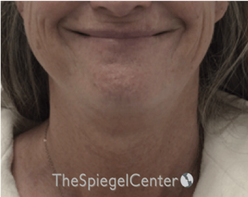 Facetite / Necktite / Embrace Before & After Gallery - Patient 162630063 - Image 3