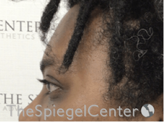 Forehead Contouring Before & After Gallery - Patient 165330643 - Image 4