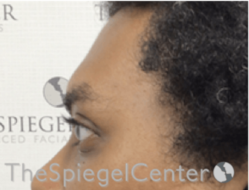 Forehead Contouring Before & After Gallery - Patient 165330643 - Image 3