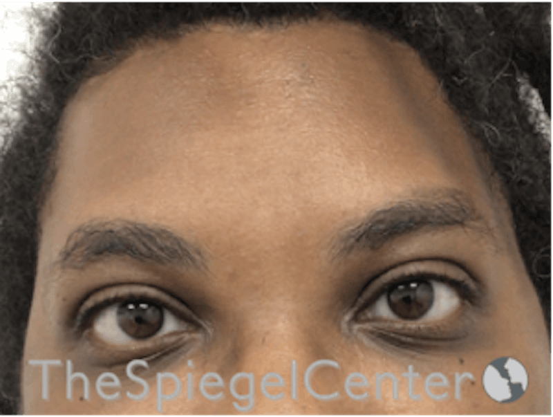 Forehead Contouring Before & After Gallery - Patient 165330643 - Image 2