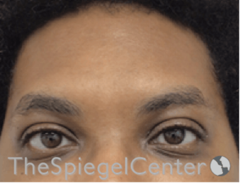 Forehead Contouring Before & After Gallery - Patient 165330643 - Image 1