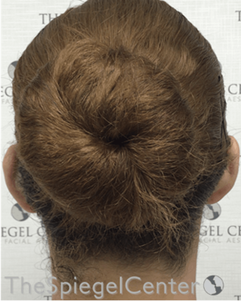 Ear Pinning / Otoplasty Before & After Gallery - Patient 165330606 - Image 2
