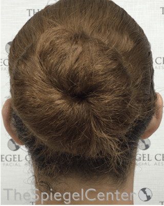 Ear Pinning / Otoplasty Before & After Gallery - Patient 165330606 - Image 2