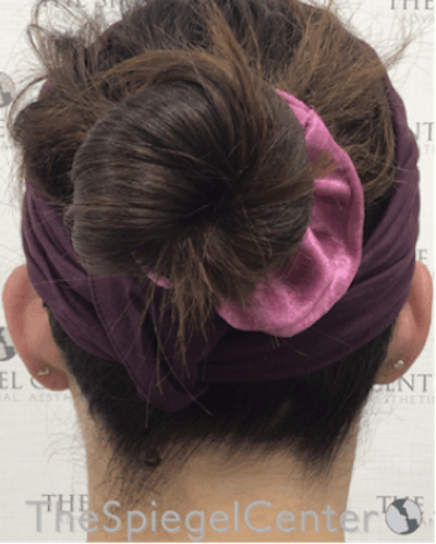 Ear Pinning / Otoplasty Before & After Gallery - Patient 165330606 - Image 1