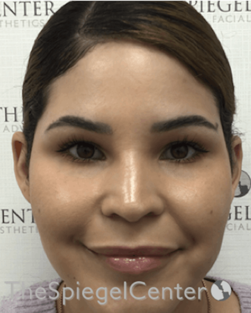 Ear Pinning / Otoplasty Before & After Gallery - Patient 165330606 - Image 4