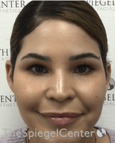 Ear Pinning / Otoplasty Before & After Gallery - Patient 165330606 - Image 4