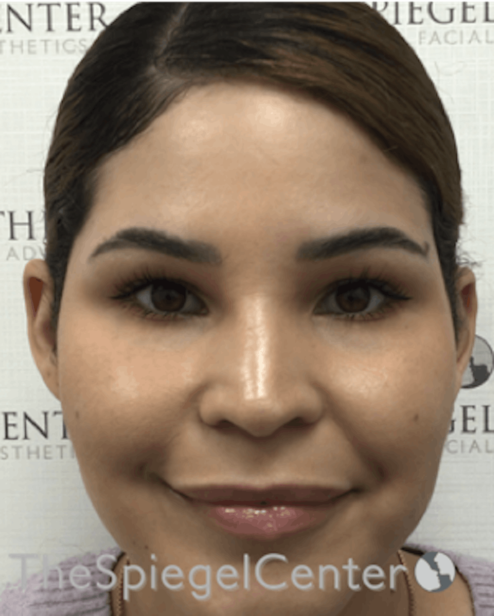 Otoplasty