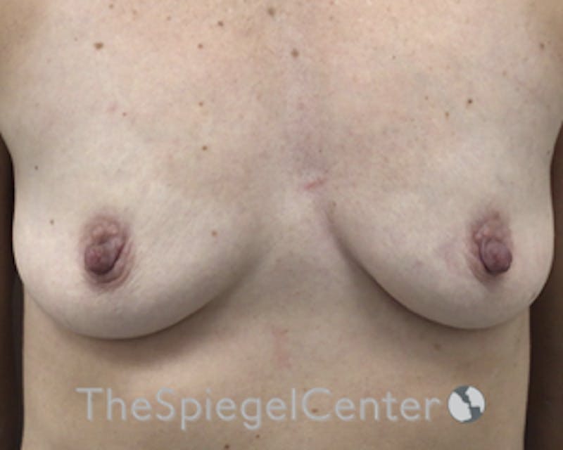Breast Augmentation Before & After Gallery - Patient 165330593 - Image 1