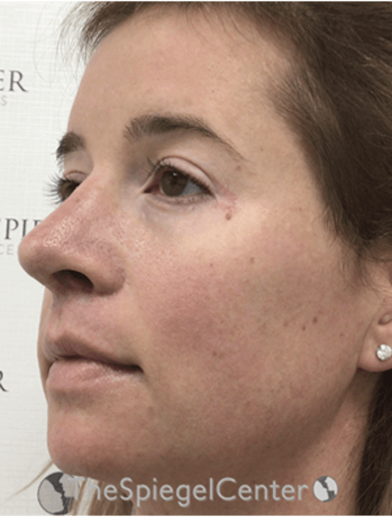 FFS Before & After Gallery - Patient 166645174 - Image 4