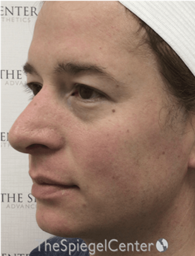 FFS Before & After Gallery - Patient 166645174 - Image 3