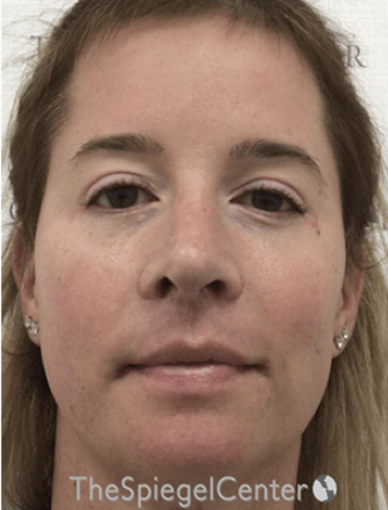 FFS Before & After Gallery - Patient 166645174 - Image 2