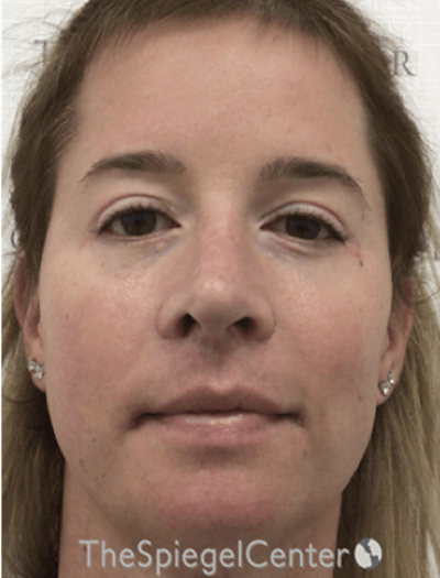 FFS Before & After Gallery - Patient 166645174 - Image 2