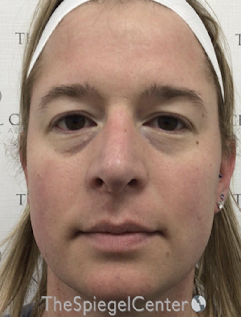 FFS Before & After Gallery - Patient 166645174 - Image 1