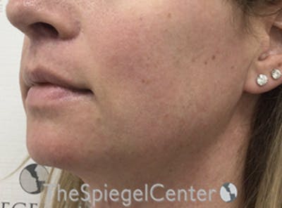 Mandible Contouring Before & After Gallery - Patient 166647313 - Image 4