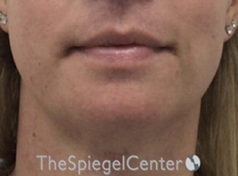 Mandible Contouring Before & After Gallery - Patient 166647313 - Image 2