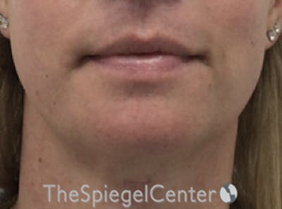 Mandible Contouring Before & After Gallery - Patient 166647313 - Image 2