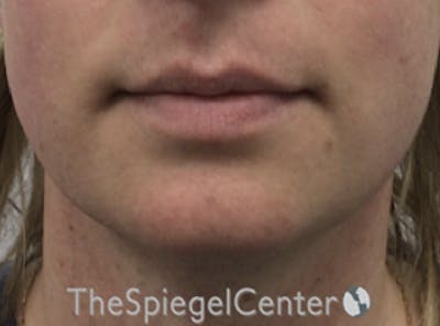 Mandible Contouring Before & After Gallery - Patient 166647313 - Image 1