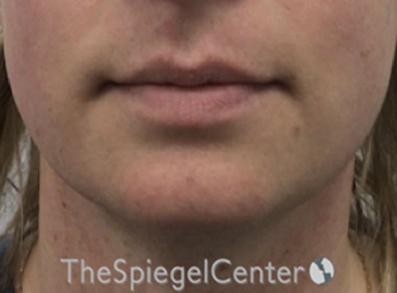 Mandible Contouring Before & After Gallery - Patient 166647313 - Image 3