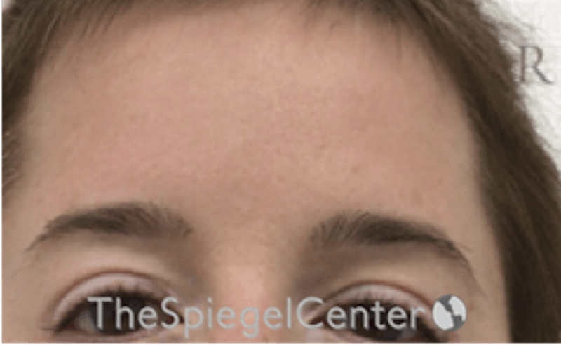 Browlift / Fox Eye Lift Before & After Gallery - Patient 166647328 - Image 2