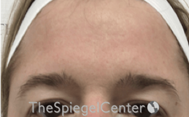 Browlift / Fox Eye Lift Before & After Gallery - Patient 166647328 - Image 1