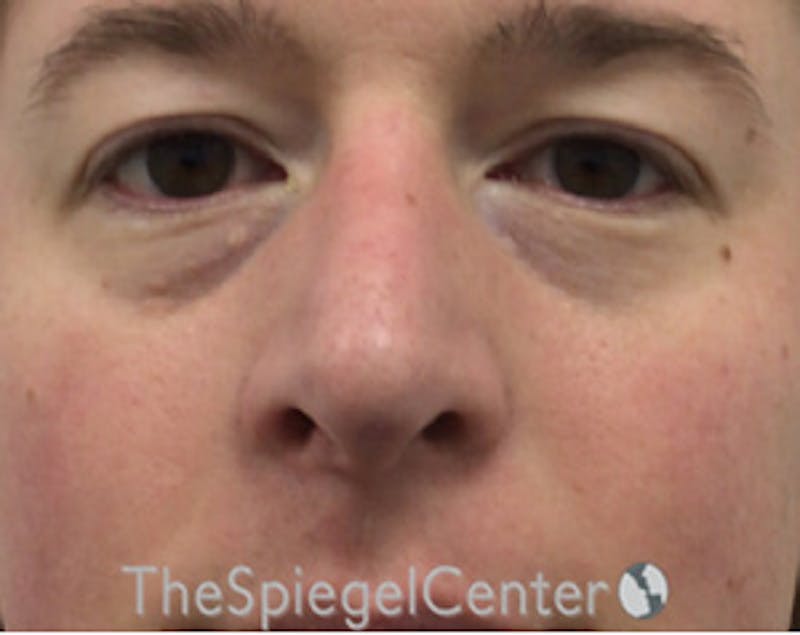 Blepharoplasty Before & After Gallery - Patient 168909749 - Image 1