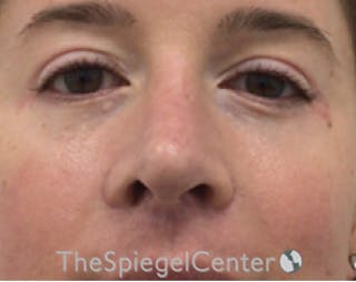 Blepharoplasty Before & After Gallery - Patient 168909749 - Image 2