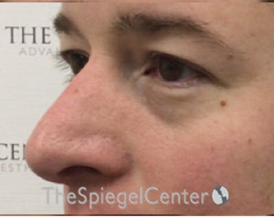 Blepharoplasty Before & After Gallery - Patient 168909749 - Image 3