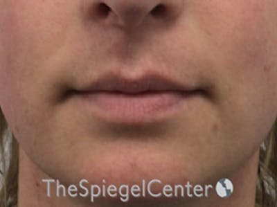 Lip Lift Before & After Gallery - Patient 168909777 - Image 1