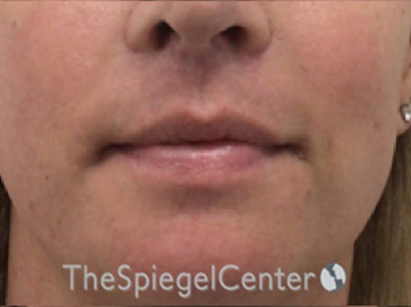 Lip Augmentation / Lip Implant / Lip Lift Before & After Gallery - Patient 168909777 - Image 2