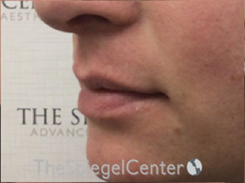 Lip Augmentation / Lip Implant / Lip Lift Before & After Gallery - Patient 168909777 - Image 3