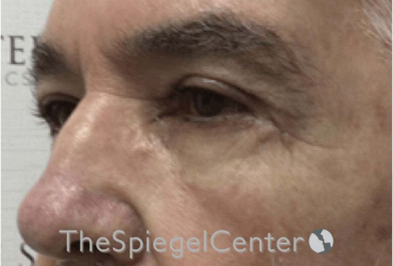 Blepharoplasty Before & After Gallery - Patient 177269766 - Image 2