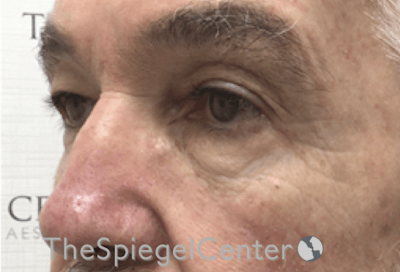 Blepharoplasty Before & After Gallery - Patient 177269766 - Image 3
