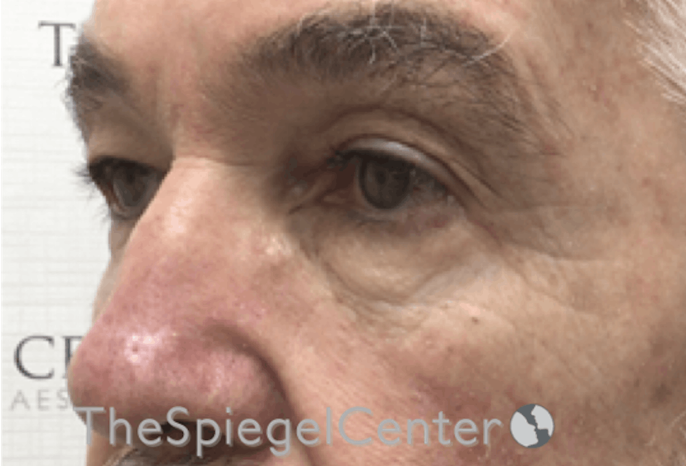 Blepharoplasty