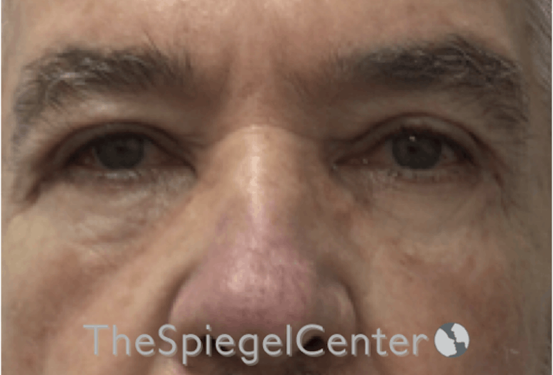 Blepharoplasty Before & After Gallery - Patient 177269766 - Image 4
